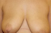Breast Asymmetry Before front view