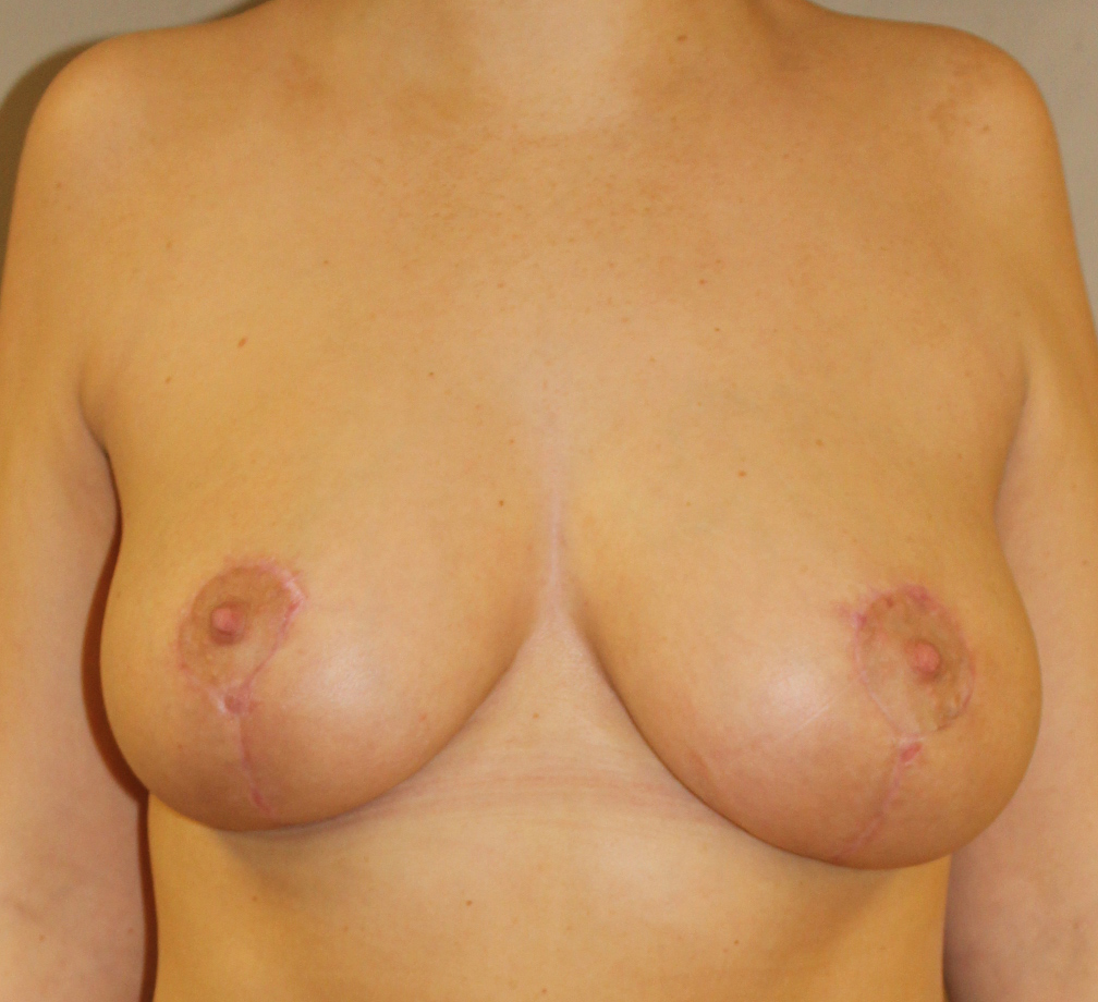 Breast Asymmetry After front view