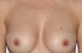Asymmetrical Breast Surgery Before After Facing