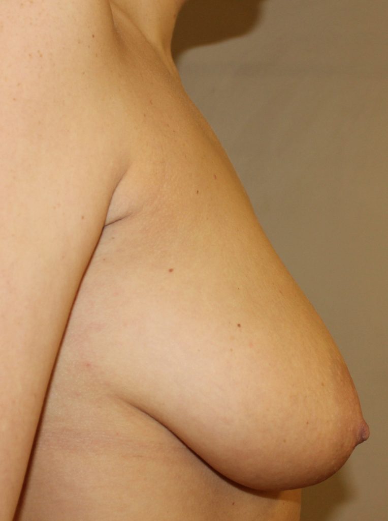 Breast Asymmetry Before Right Side view