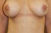 Front view Mummy Makeover Post Op case study 9