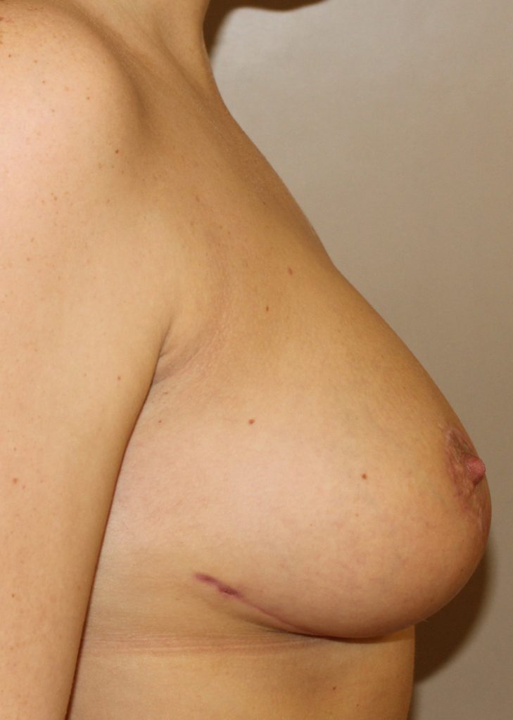 Breast Asymmetry After Right Side view