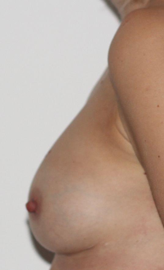 Asymmetrical Breast Surgery After Left Side view
