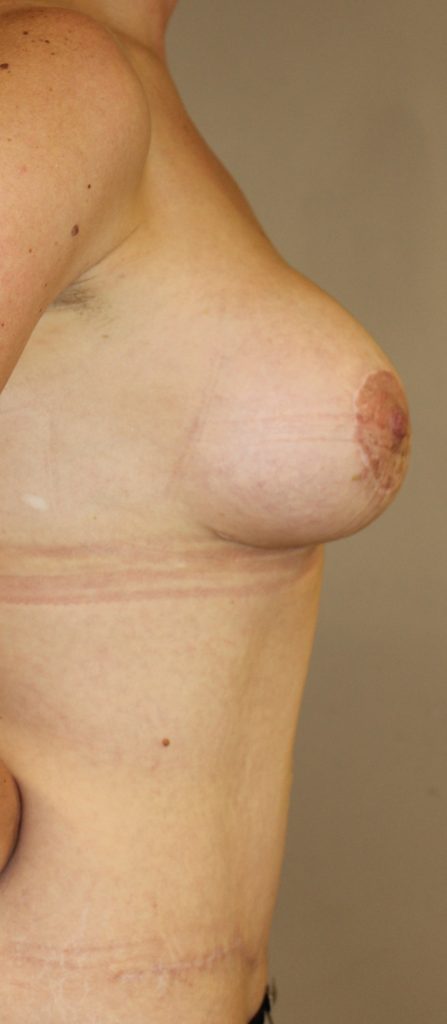 Right side view of mummy makeover post op case study 9