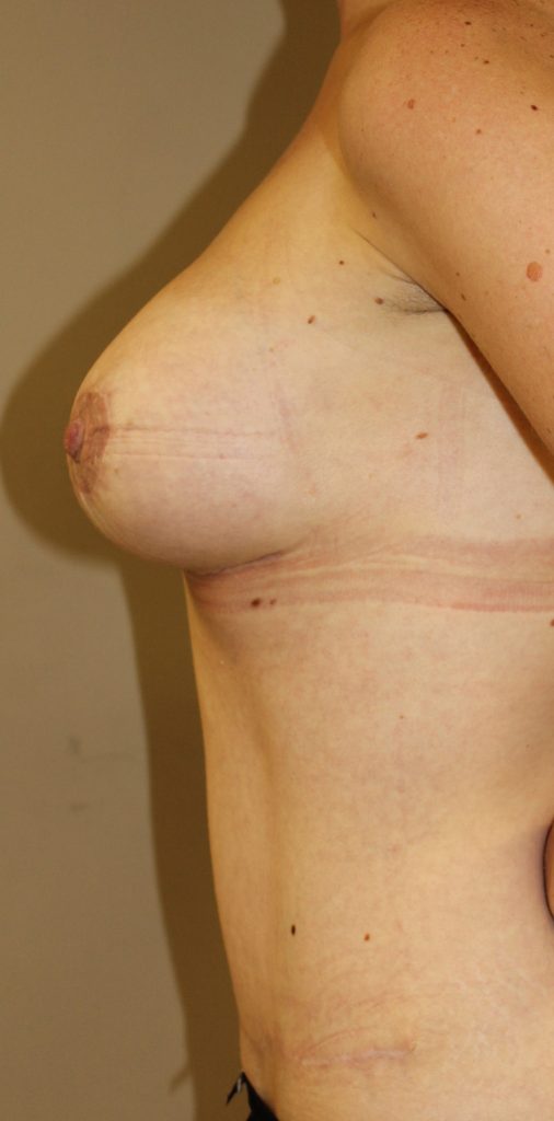 Left side view mummy makeover post op case study 9
