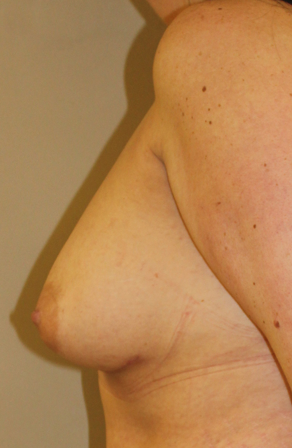 Breast Augmentation After Left side view