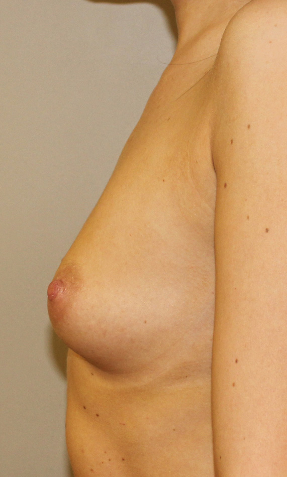 Brunette med skin Breast Asymmetry Before Left Side View