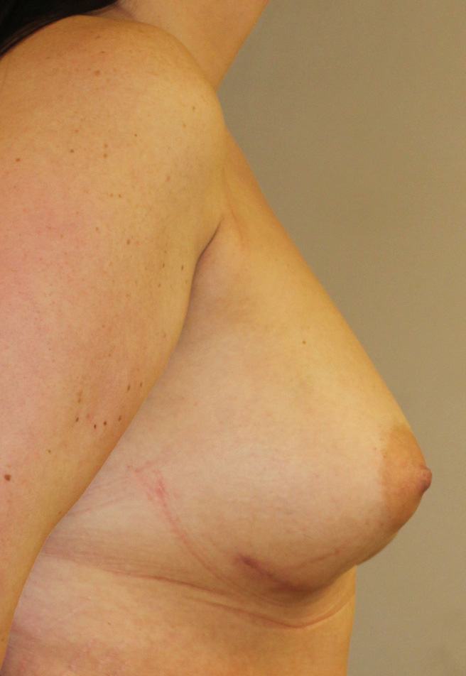Breast Augmentation After Right side view