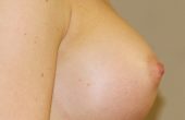 Brunette med skin Breast Asymmetry After Side View