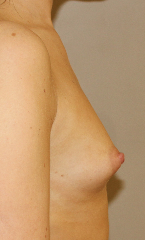 Brunette med skin Breast Asymmetry After Left Side View