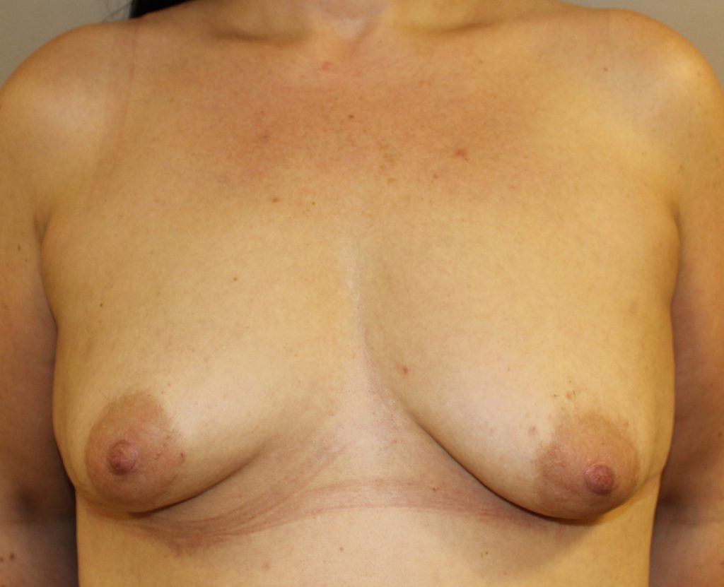 Breast Augmentation Before Front View