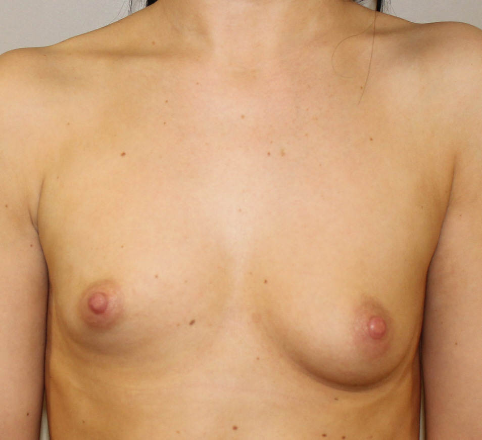 Brunette med skin Breast Asymmetry Before Front View