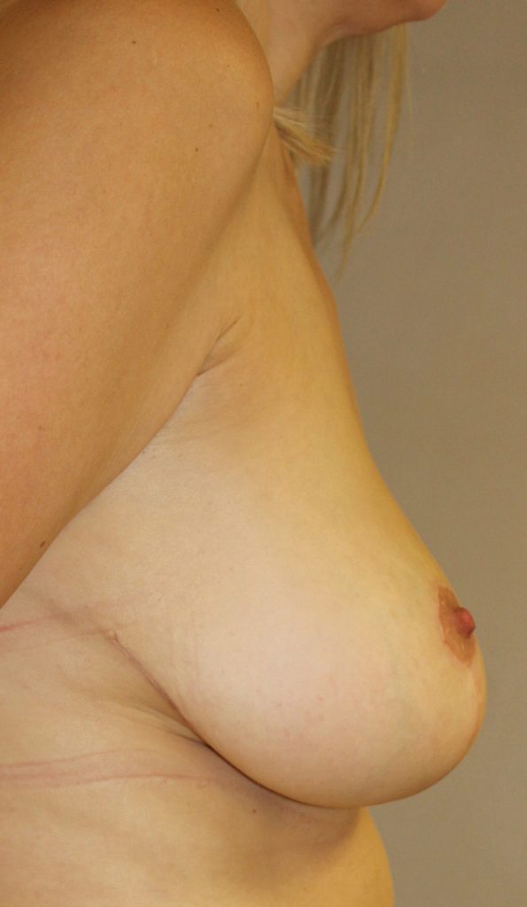 Breast Asymmetry Blonde After Right Side View