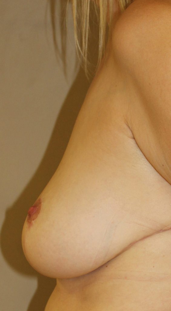 Breast Asymmetry Blonde After Left Side View