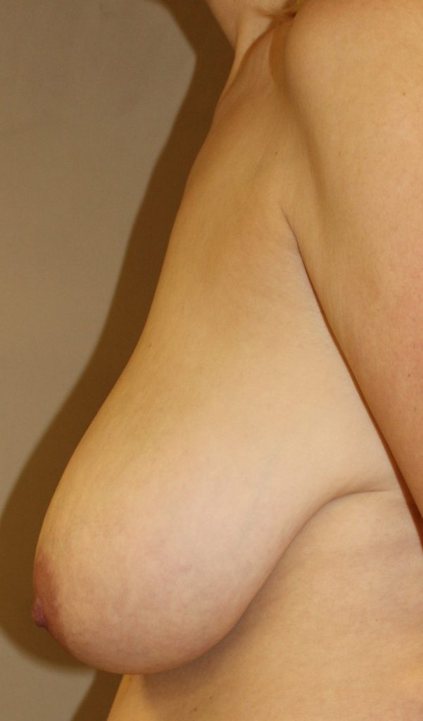 Breast Asymmetry Blonde Before Left Side View