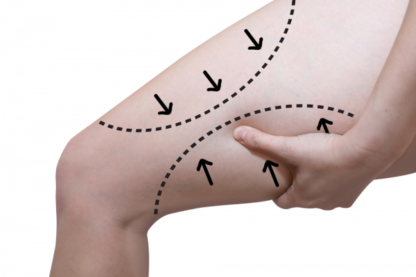 leg marked with lines for thigh lift surgery