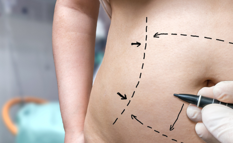 5 Tips For Recovery After Tummy Tuck Procedure